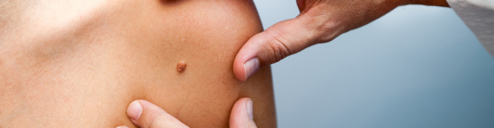 Curso Superior en Dermatologia para Titulados Universitarios en Enfermeria