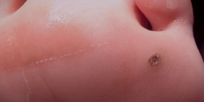 Especialista en Virus del Papiloma Humano Especialista en Virus del Papiloma Humano