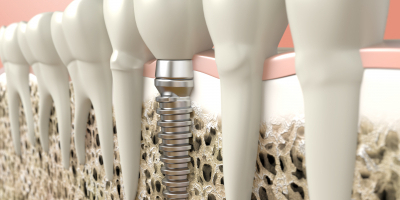 Especialista en Prótesis Dentales Completas Especialista en Prótesis Dentales Completas