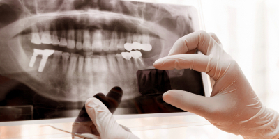Experto en Radiología Dental + Titulación Universitaria en Radiología (Doble Titulación + 8 Créditos ECTS) Experto en Radiología Dental + Titulación Universitaria en Radiología (Doble Titulación + 8 Créditos ECTS)