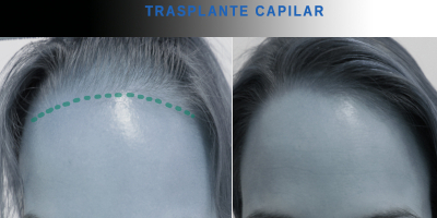 Master en Tricología e Implantología Capilar Master en Tricología e Implantología Capilar