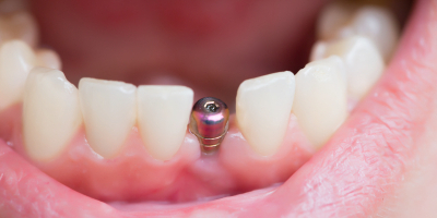 Postgrado en Endodoncia + Titulacion Universitaria Postgrado en Endodoncia + Titulacion Universitaria