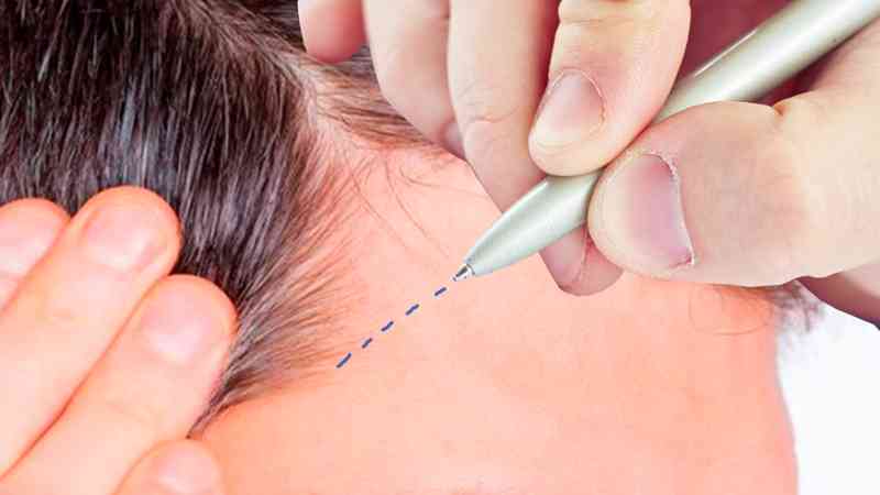 Curso De Micropigmentacion Capilar