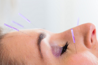 Acupuntura