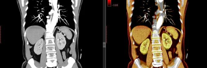 ¿Qué se diagnostica con una tomografía axial computarizada del abdomen?